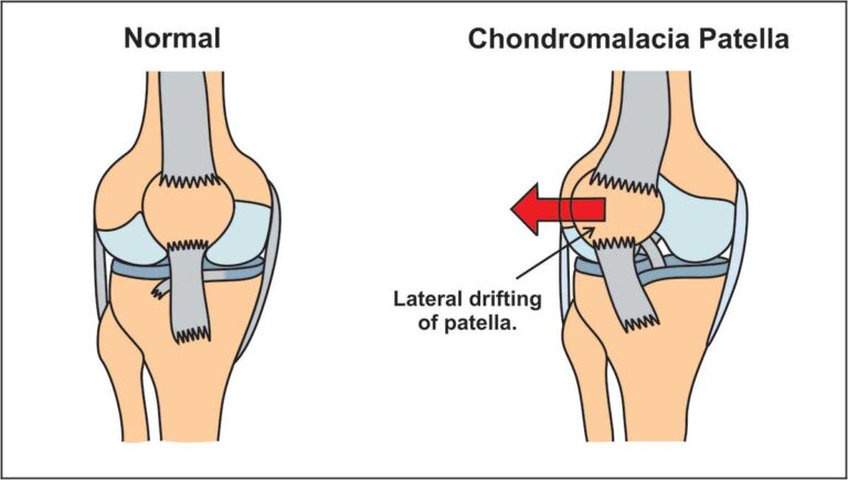 نرمی کشکک - Chondromalacia patellae